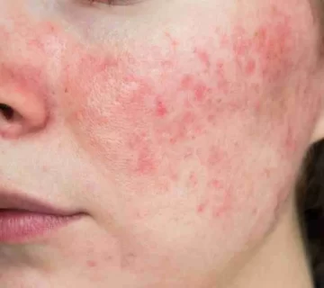 Pelle con rosacea 1024x768 1 360x320